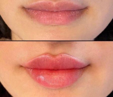 تزریق ژل لب برای حجم‌دهی