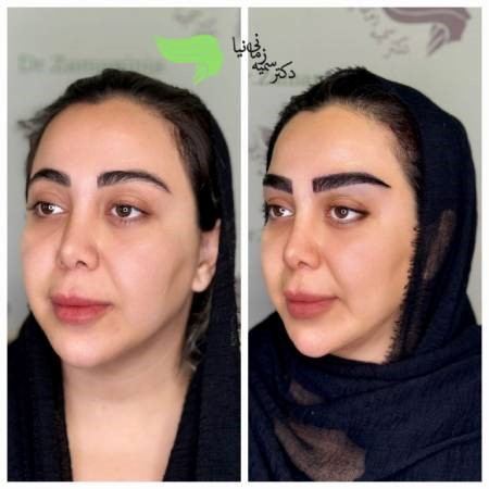 مدل های جدید کاشت ابرو ۲۰۲۵: قبل از انتخاب حتما ببینید