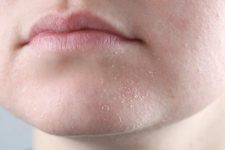 چگونه از خشکی و ترک پوست در نواحی مختلف بدن جلوگیری کنیم؟
